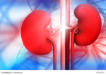 preventing kidney stones